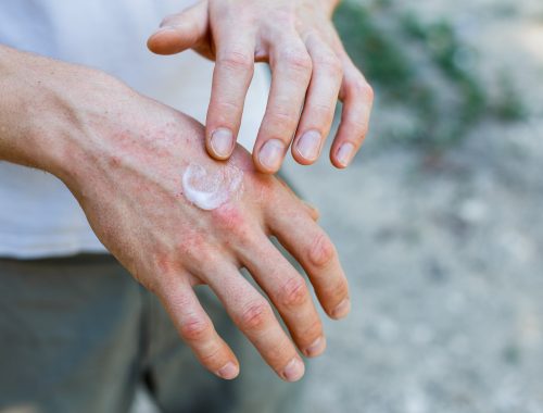 ¿Por qué los productos de limpieza contra la COVID pueden agravar las lesiones en la piel?