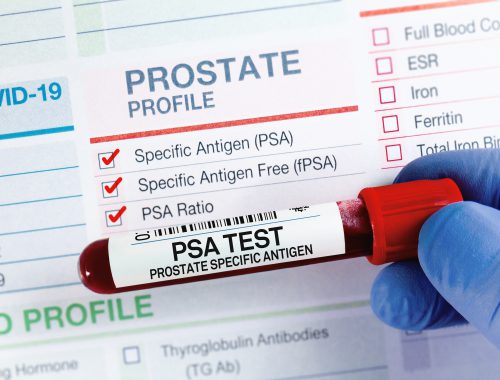 psa-test-biomarcador-prostata
