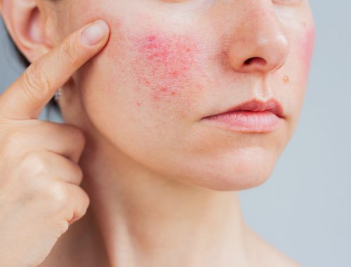 rosacea-enrojecimiento-cara