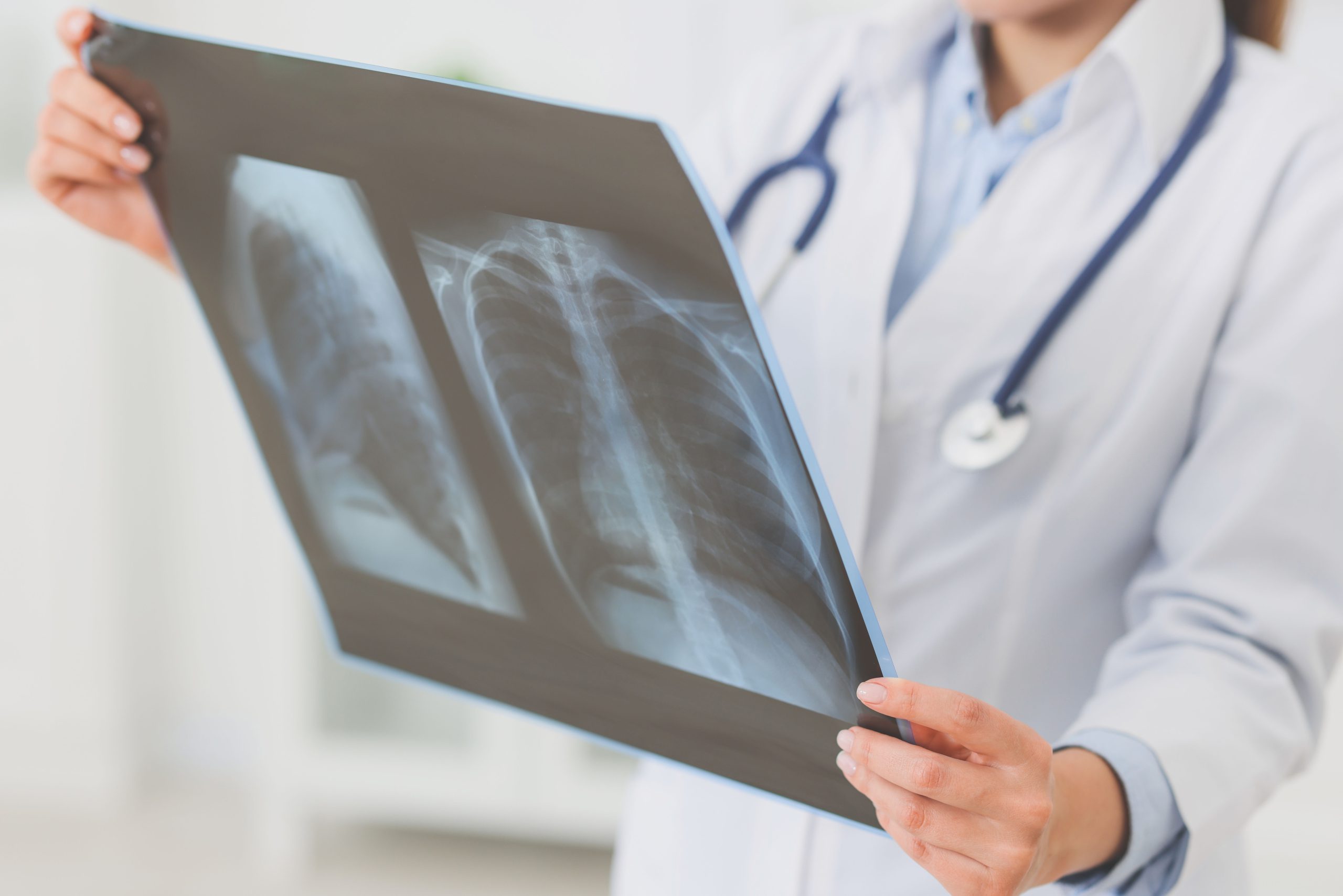 embolia-pulmonar-sintomas_BLOGHLA