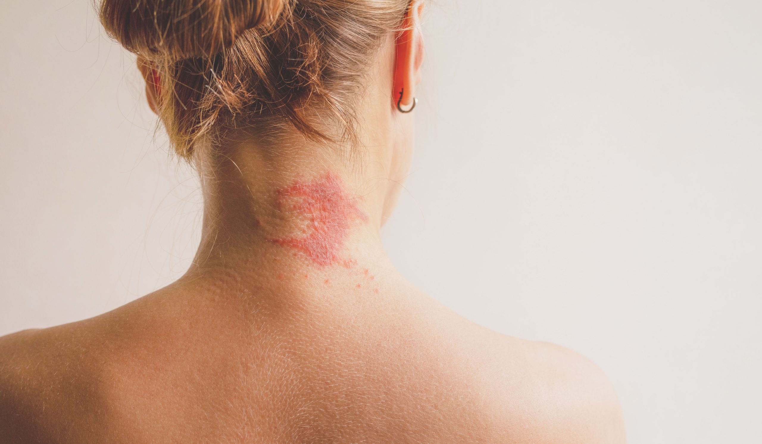 diez-tipos-dermatitis